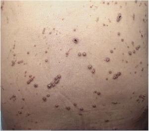 Multiple, erythematous, excoriated umbilicated papules with central adherent keratotic plugs.