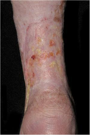 Healed venous ulcer, featuring only some exulcerated and hyperkeratotic areas.