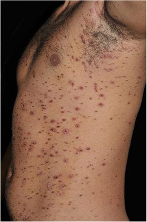 PLEVA: papulonecrotic lesions and papules with necrotic crusts. Treatment with metotrexate and systemic corticosteroids.