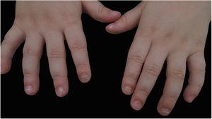 Hands from patient with 3 years old, showing Beau lines in almost every nail, and onychomadesis in second (both sides) and fourth finger.