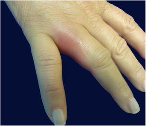 Right hand: edema and erythema on the fourth finger.