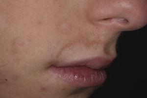 Achromic spots surrounded by halo erythematosus and polios is in beard hairs in the malar and right perioral regions.