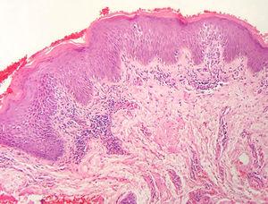 Superficial perivascular lymphoid infiltrate and insufficient amount of lymphocytes in the epidermis to characterize epidermotropism. In addition, there are hyperkeratosis, parakeratosis and acanthosis (Hematoxylin & eosin, x100).