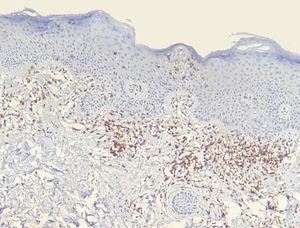 CD3+ cells comprise most of dermal infiltrate and are also seen in the epidermis (Immunohistochemistry, x40).