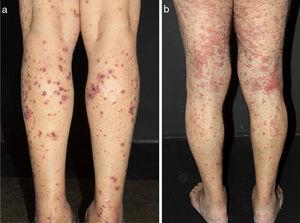 Different lesions usually seen in patients with small vessel vasculitis. (a) Purpura, petechiae, vesicles and hemorrhagic blisters in the lower limbs in a patient with cryoglobulinemic vasculitis, (b) Urticated sometimes confluent lesions and purpura in the lower limbs very suggestive of urticaria vasculitis.