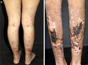 Distinct lesions normally found on the skin of patients with medium vessel vasculitis: (a) Subcutaneous nodules and ulcers in a patients with cutaneous arteritis, (b) Extensive ulcers with areas of necrosis and residual atrophic scars in the lower limbs of a patients with microscopic polyangiitis.