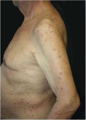 Widespread excoriations and dome-shaped papules with central crusts on the trunk and upper extremity.