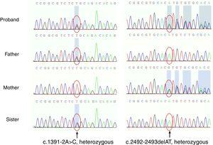 Two novel heterozygous variants in the RECQL4 gene confirmed by gene sequencing. One was in the splice site, c.1391-2A>C from her father, and also was seen in her sister. The other was a deletion mutation, c.2492_2493delAT (p.His831Argfs) from her mother.