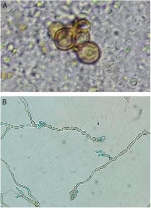 (A and B) Direct examination: fumagoid bodies. Microculture: septate demaceous hyphae and elliptical conidia in the upper portion of simple or slightly branched conidiophores – phenotypic characteristics compatible with Rhinocladiella spp. (KOH-20%, ×400; blue, lactophenol, ×400).