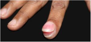Hypertrophy of the distal phalanx associated with increased nail bed convexity.