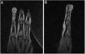 Nodular formation on the dorsal surface of the distal segment of the finger, located superficially to the phalanx, causing adjacent bone remodeling and bulging the skin surface.