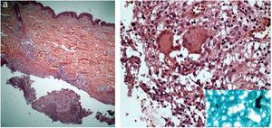 (A) Superficial and deep lymphohistiocytic and granulomatous infiltrate, with suppuration and organized abscesses (Hematoxylin & eosin, x200). (B) In detail, acid-fast bacilli are noted in the purulent secretion (Hematoxylin & eosin, x400).