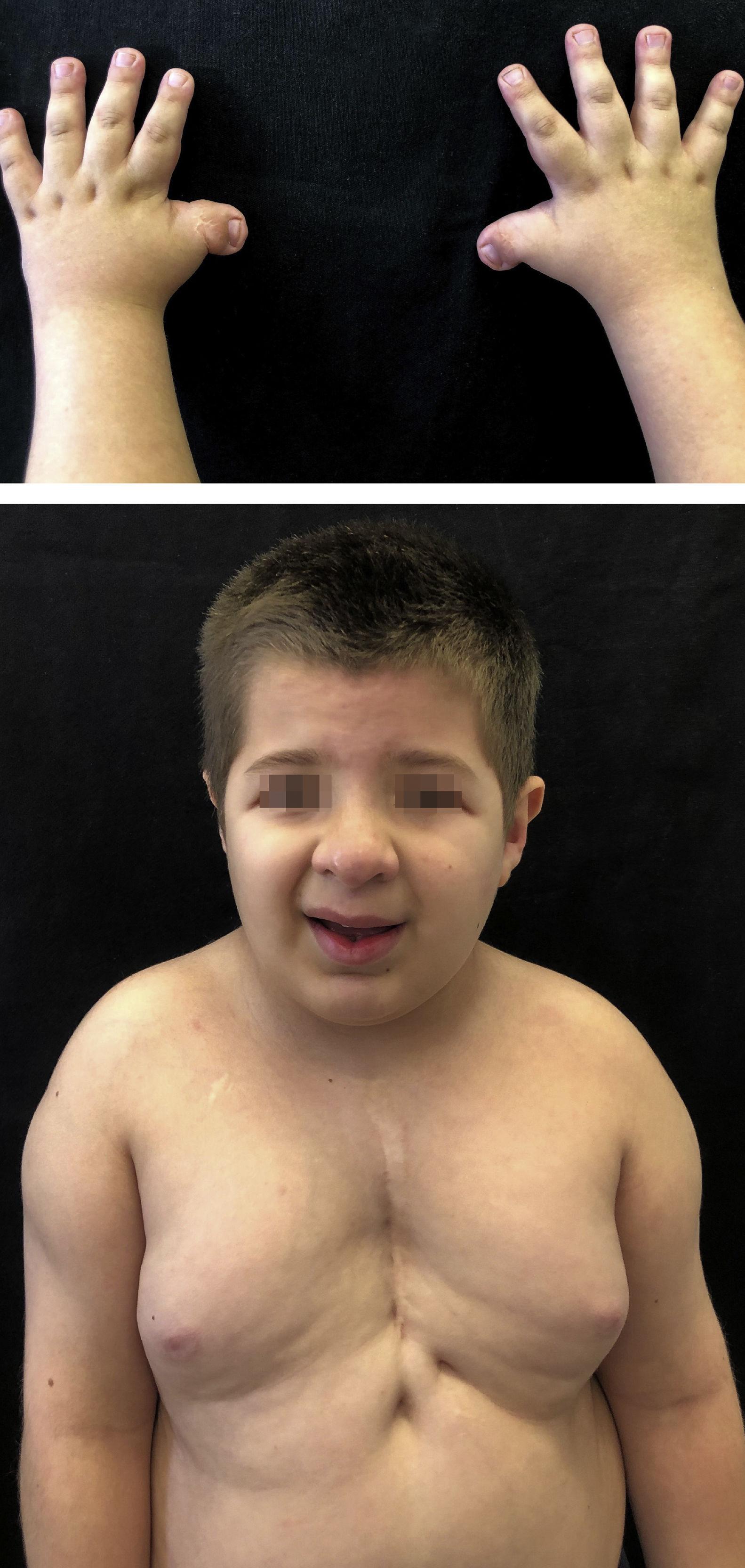 Rubinstein-Taybi syndrome: A report of two siblings with