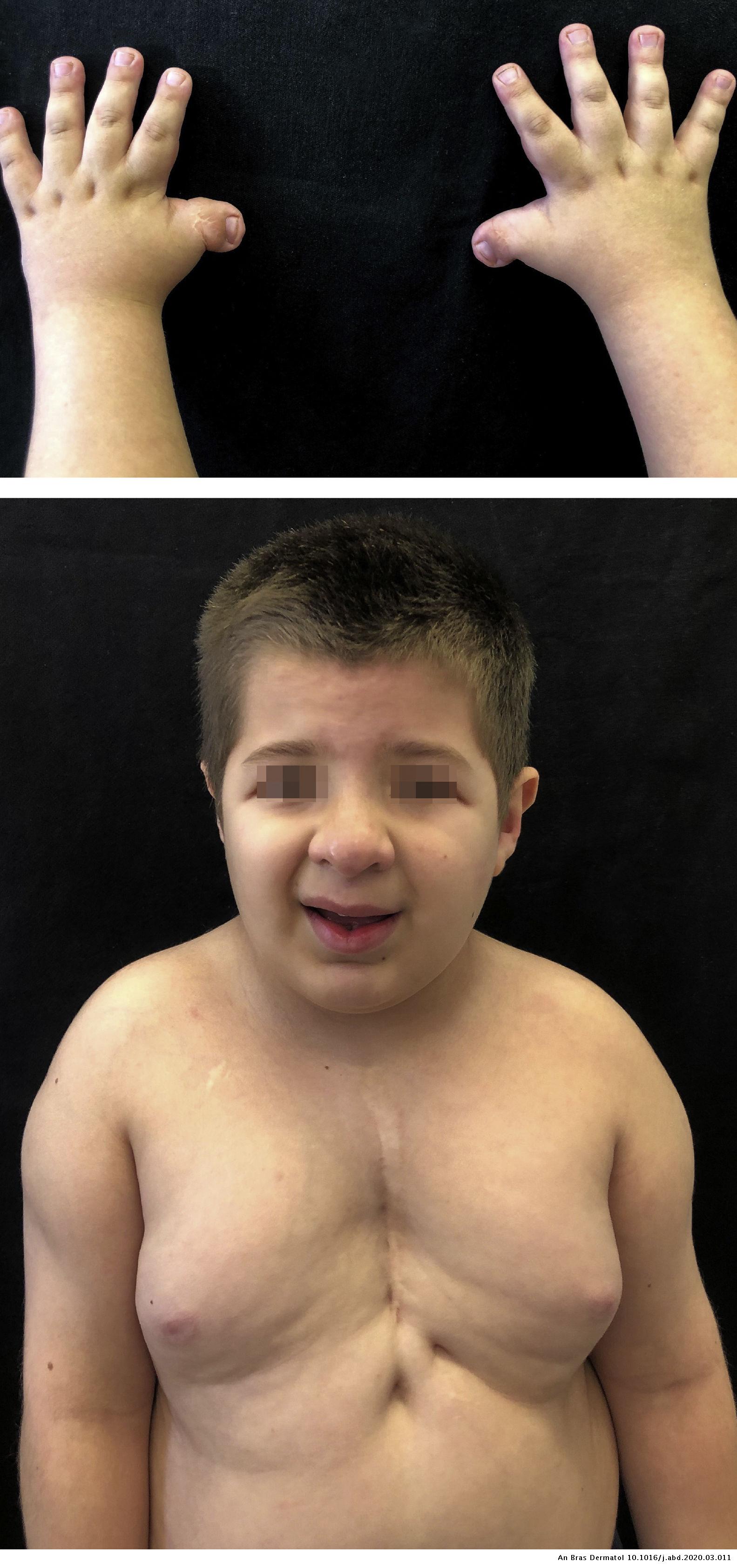 Multiple pilomatricomas in twins with Rubinstein-Taybi syndrome
