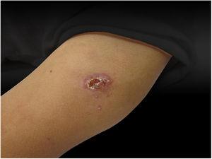 Dermatosis located in the upper portion of the left arm, characterized by an erythematous ulcer with well-defined edges and a granular bottom measuring approximately 1.5cm in diameter.