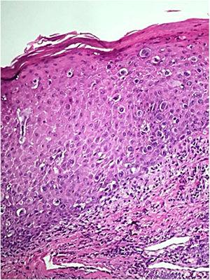 Epidermis showing infiltration by atypical epithelial cells with broad and clear cytoplasm (Hematoxylin & eosin, x100).