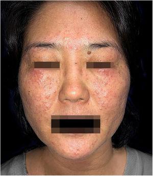 Erythematous papules on the malar areas, forehead and chin. Plaques formed by coalescence of papules on both eyelids.