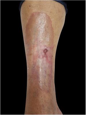 Small hyperkeratotic ulcerated plaque on a necrobiosis lipoidica lesion.