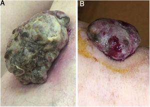 (A) Sessile nodular mass, 1.8×4.5cm on its greatest dimension, surrounded by an erythematous halo on the anterior area of the leg. Necrotic and fibrinous areas and gauze filaments incorporated within the tumor surface can be observed. (B) Broad-based sessile nodule (1.5×3.8cm on its greatest dimension) on the anterior area of the leg, deforming the underlying skin. Necrotic and fibrinous areas and bleeding are evident.