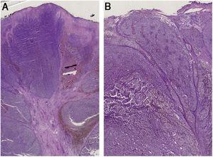 (A) Histopathology shows fibroepithelial branches subdividing the tumor into lobules. Pigment distribution is irregular, both in terms of quantity and depth. Pleomorphic vessels and ulceration are visible throughout the lesions. (B) Histological findings include ulceration, atypical polymorphic vessels with scattered depositions of pigment, and absence of rete ridges. Inflammatory infiltrate is scarce.