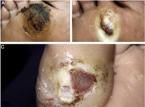 (A), hyperkeratosis and hematic crusts on the forefoot; (B), after cleaning, granular and hyperkeratotic ulcer; (C), ulcer with callous edges on the hallux.