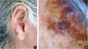 (A), Asymmetric, multicolored, and irregularly contoured pigmented area on the right ear lobe. (B), Dermoscopy suggestive of melanoma, lentigo maligna subtype: homogeneous bluish-gray area with rhomboidal structures (white circle); pigmentation of follicular openings (red arrows); circle within a circle (yellow arrows).