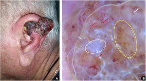 (A), Erythemato-violaceous exophytic tumor affecting the left ear helix with the presence of confluent satellite papules. (B), Dermoscopy suggestive of nodular melanoma: bluish-white veil (white circle); atypical vascular pattern, with irregular linear vessels (red arrows) and milky red globules (white arrow); irregular dots and globules of asymmetric distribution (yellow circle).