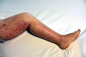 Macroscopic appearance of lesions on legs.