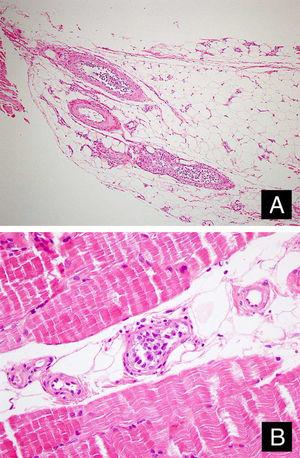 Tumor cells in the lumens of vessel in the subcutaneous adipous tissue (A: Hematoxylin & eosin, ×100) and muscular tissue (B: Hematoxylin & eosin, ×400).