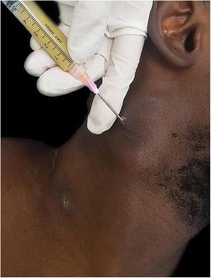 Collection of cervical abscess material by puncture with a thick needle.