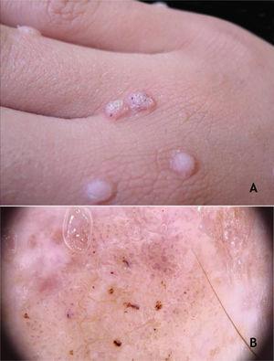 (A), Common wart, papules with keratotic surface, some with dark spots. (B), common wart at dermoscopy, vessels surrounded by a white halo and hemorrhagic dots. Source: Dermatology Service of HC-UFMG/EBSERH.