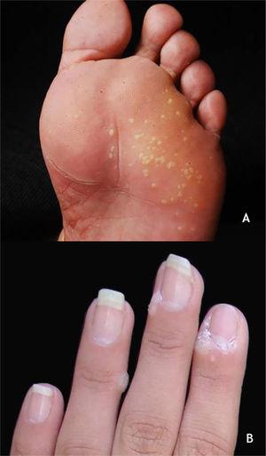 (A), Mosaic plantar wart. (B), periungual wart. Source: Dermatology Service of HC-UFMG/EBSERH.