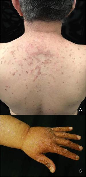 (A), Epidermodysplasia verruciformis, erythematous and/or brownish plaques that resemble pityriasis versicolor lesions and seborrheic keratosis on the trunk. (B), WILD syndrome, numerous flattened erythematous papules forming plaques on the back of the hand and forearm, associated with lymphedema of the upper limb. Source: Dermatology Service of HC-UFMG/EBSERH.