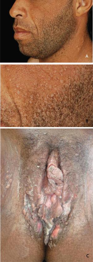 (A and B) Flat warts in a transplanted patient. (C), Condyloma acuminatum in an HIV-positive pregnant woman, showing multiple papules and condylomatous plaques, some eroded (secondary to the use of topical medication) affecting a large area. Source: HC-UFMG/EBSERH.