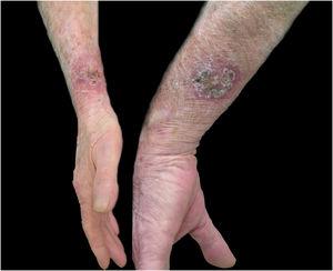 Sporotrichosis, cutaneous form of multiple inoculation in both forearms presented by case 16.