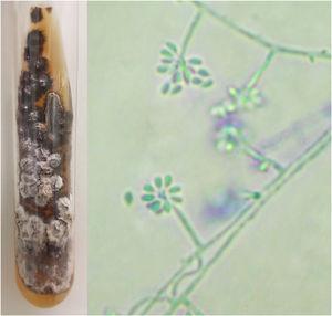 Phenotypic aspects of Sporothrix sp. Macromorphology on Mycosel agar medium at 25 °C with white to beige and black bicolor filamentous colony, and potato agar micromorphology (cotton blue, ×400) showing hyaline septate hyphae with conidiophores, with hyaline conidia at the extremities in a “daisy” arrangement.