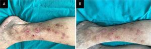 Case 1, (A), Multiple irregularly shaped erythematous or hyperpigmented, eroded, excoriated, or lichenified papules and nodules of varying size on the right leg of the patient with neurotic excoriation. (B), Partial clinical improvement after 2-weeks on N-acetylcysteine treatment.
