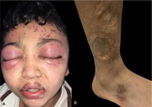 (A), Periorbital edema, and erythema with left frontal vesico-blisters with hemorrhagic content. (B), Multiple atrophic and some anetodermic scars on the lower limbs.