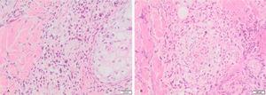 (A), Atypical perivascular and perianexial lymphoid infiltrates. (B), Angiocentricity.