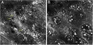 Reflectance confocal microscopy showing (A), irregular and disarranged honeycomb pattern and several bright, roundish nucleated cells with a targetoid appearance (arrows) in the epidermis. (B), edged papillae and multiple bright plump cells in the papillary dermis.