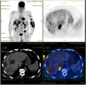 PET-CT scan showing the progression of Kaposi’s Sarcoma with metastatic involvement of the liver in a patient with previously known gastrointestinal and pulmonary involvement. This patient later died despite multiple treatments, including doxorubicin, alfa-interferon, paclitaxel, vinorelbine, and radiotherapy.