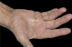 Dupuytren’s contracture. Dr. Alexandre Gripp’s personal collection.