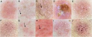 Dermoscopy findings of the patch tests: (a), Homogeneous erythema; (b), Perifollicular erythema (arrow); (c), Papules (arrow); (d), Crusts; (e), Vesicles; (f), Follicular accentuation (atopic patient); (g), Linear vessels; (h), Petechiae (arrow); (i), Pustules; (j), Pore reaction pattern.