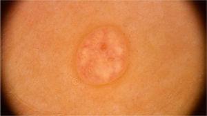 Dermoscopic image of molluscum contagiosum showing central umbilication, white-yellowish globular structures and predominantly peripherally distributed vessels. (FotoFinder, original magnitude ×20). Source: Collection of Hospital de Clinicas de Porto Alegre.