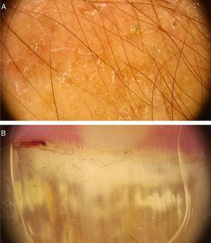 Dermoscopic image of tinea corporis showing areas of erythema and scaling (A) and of onychomycosis showing white-yellowish streaks in the proximal portion of the nail plate (B). (FotoFinder, original magnitude ×20). Source: Authors' personal collection.