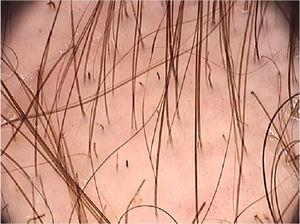 Dermoscopic image of tinea capitis showing broken and “comma-shaped” hairs (FotoFinder, original magnitude ×20). Source: Authors' personal collection.