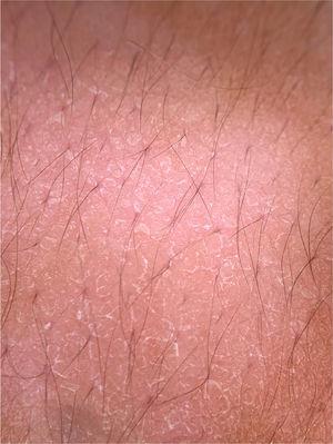 Dermoscopic image of pityriasis versicolor, demonstrating diffuse fine scaling. (FotoFinder, original magnitude ×20). Source: Authors' personal collection.
