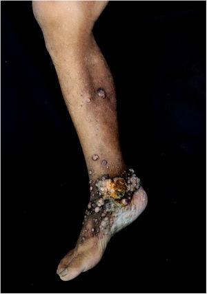 Keloid-like papules and nodules on the right lower limb.