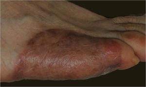 Six-month follow-up shows excellent engraftment without skin retraction or ulceration.