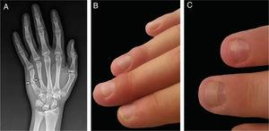 Clinical and radiological images of the second patient. (A), Fourth and fifth metacarpal bone fractures (X-Ray image). (B), Nail fold edema of the third and fourth fingers. (C), Onychomadesis in the two fingers.